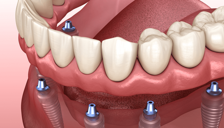 Painful are Dental Implants