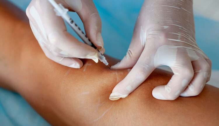 Opt For Sclerotherapy