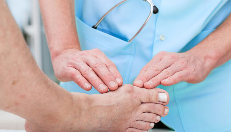 Need to Know About Bunions