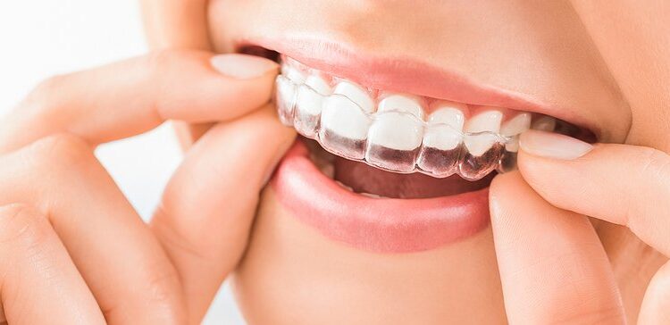 Realize the Best Invisalign